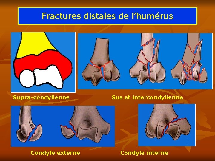 Fractures distales de l’humérus Supra-condylienne Condyle externe Sus et intercondylienne Condyle interne 