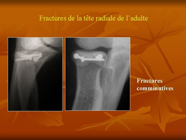 Fractures de la tête radiale de l’adulte Fractures comminutives 