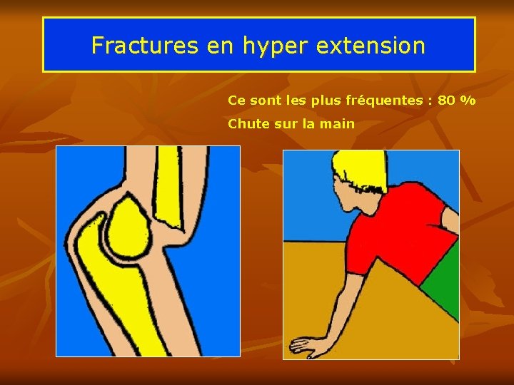 Fractures en hyper extension Ce sont les plus fréquentes : 80 % Chute sur