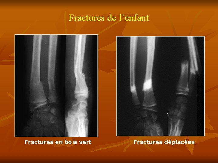 Fractures de l’enfant Fractures en bois vert Fractures déplacées 