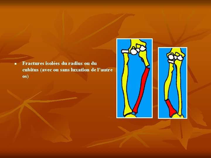 n Fractures isolées du radius ou du cubitus (avec ou sans luxation de l’autre