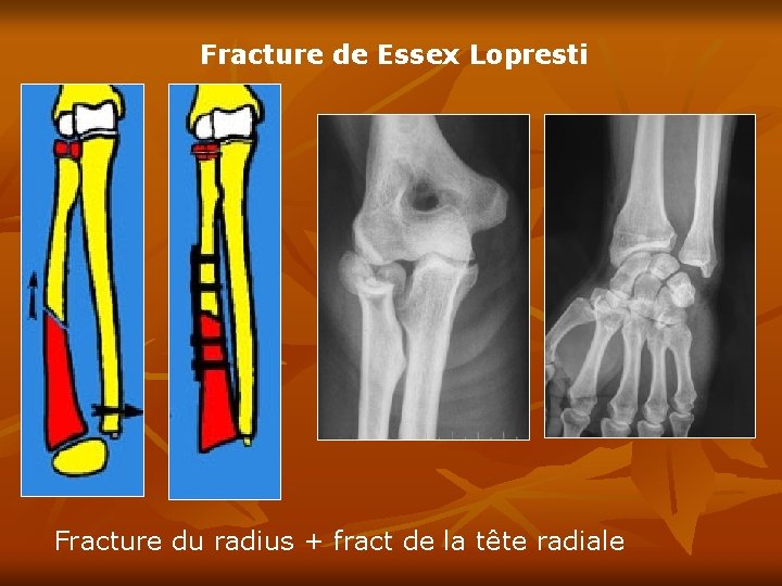 Fracture de Essex Lopresti Fracture du radius + fract de la tête radiale 