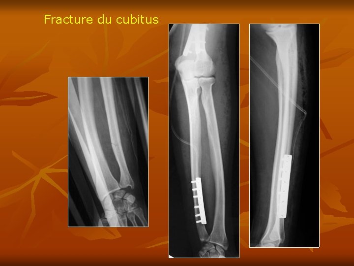 Fracture du cubitus 