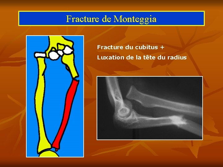 Fracture de Monteggia Fracture du cubitus + Luxation de la tête du radius 