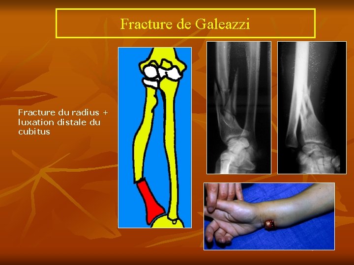 Fracture de Galeazzi Fracture du radius + luxation distale du cubitus 