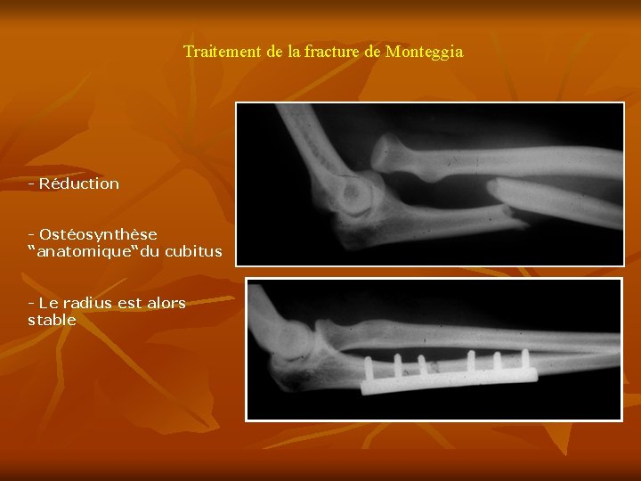 Traitement de la fracture de Monteggia - Réduction - Ostéosynthèse “anatomique“du cubitus - Le