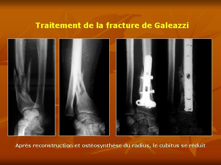 Traitement de la fracture de Galeazzi Après reconstruction et ostéosynthèse du radius, le cubitus