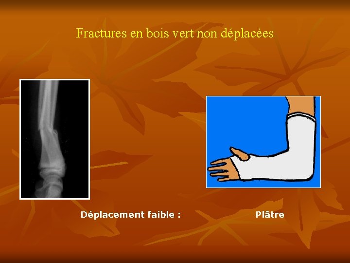 Fractures en bois vert non déplacées Déplacement faible : Plâtre 