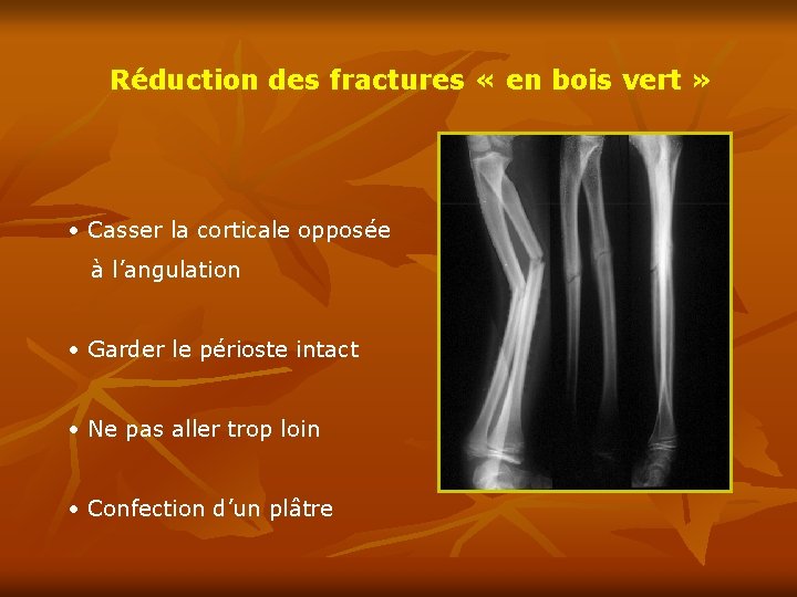 Réduction des fractures « en bois vert » • Casser la corticale opposée à