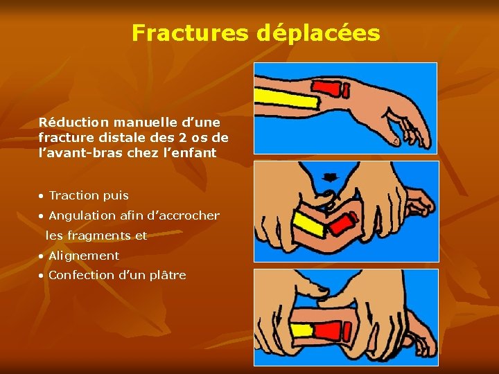 Fractures déplacées Réduction manuelle d’une fracture distale des 2 os de l’avant-bras chez l’enfant