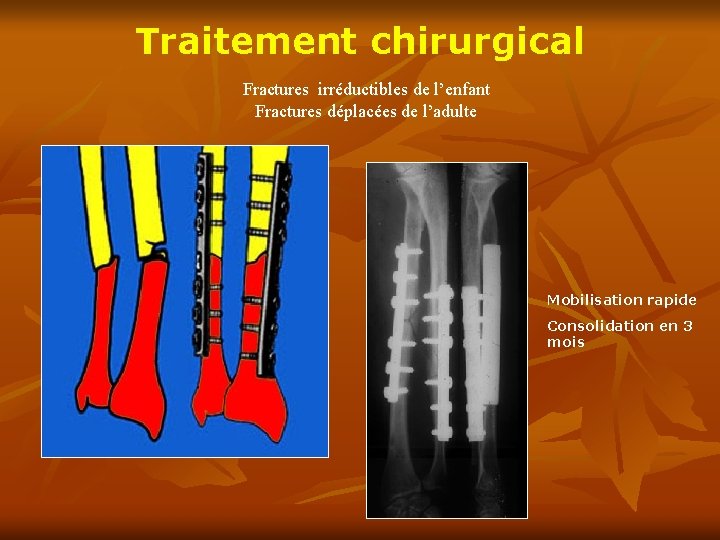 Traitement chirurgical Fractures irréductibles de l’enfant Fractures déplacées de l’adulte Mobilisation rapide Consolidation en