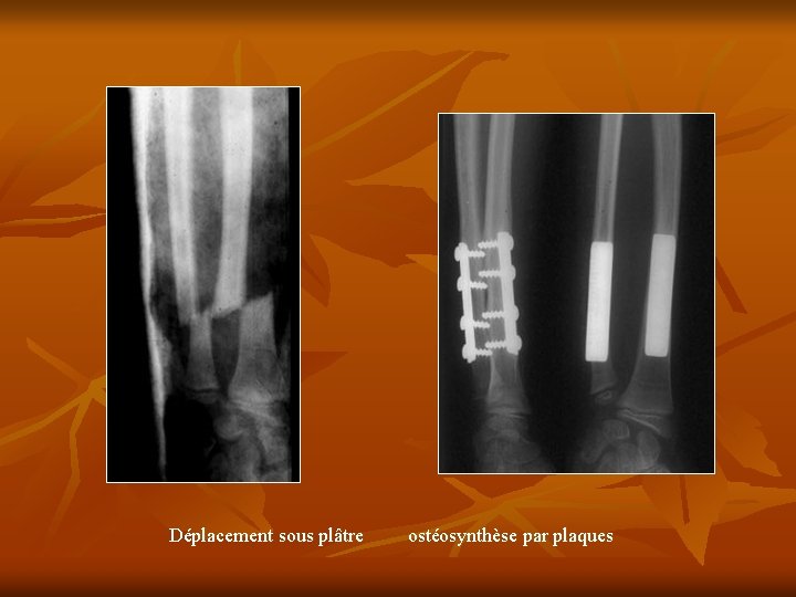 Déplacement sous plâtre ostéosynthèse par plaques 