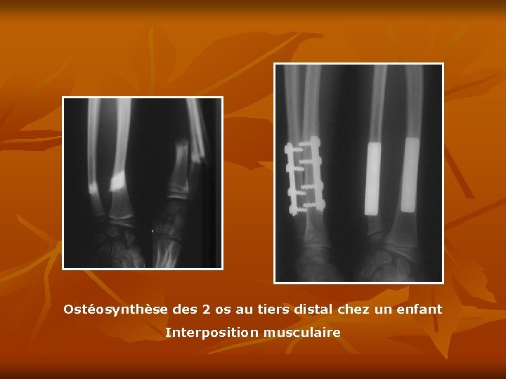 Ostéosynthèse des 2 os au tiers distal chez un enfant Interposition musculaire 