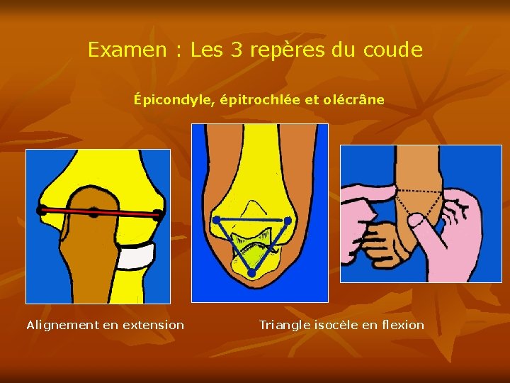 Examen : Les 3 repères du coude Épicondyle, épitrochlée et olécrâne Alignement en extension