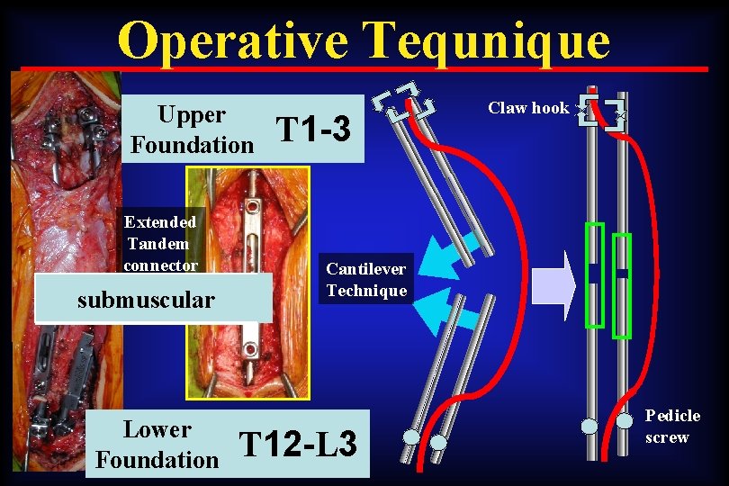 Operative Tequnique Upper Foundation Extended Tandem connector submuscular Lower Foundation T 1 -3 Claw