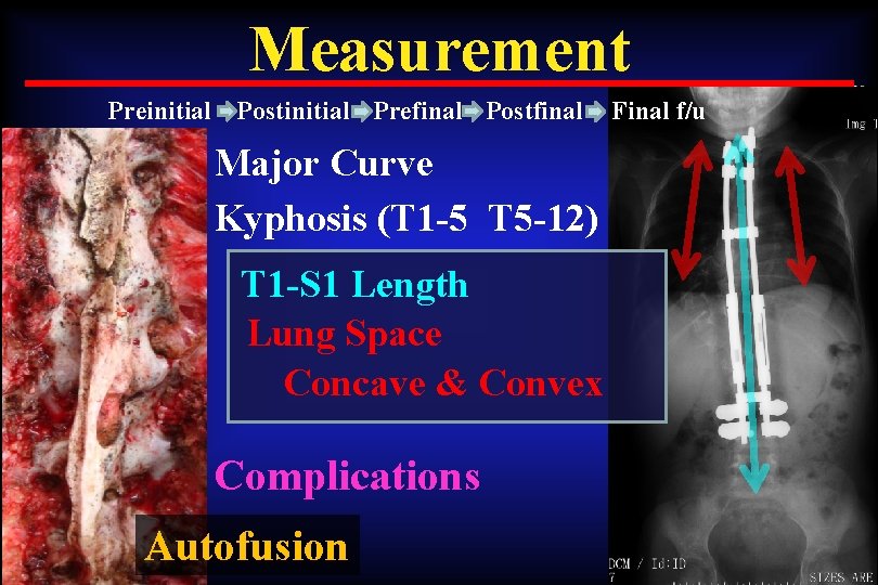 Measurement Preinitial Postinitial Prefinal Postfinal Major Curve Kyphosis (T 1 -5 T 5 -12)