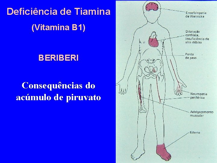 Deficiência de Tiamina (Vitamina B 1) BERI Consequências do acúmulo de piruvato 