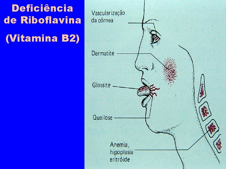 Deficiência de Riboflavina (Vitamina B 2) 