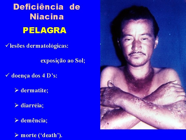 Deficiência de Niacina PELAGRA ülesões dermatológicas: exposição ao Sol; ü doença dos 4 D’s: