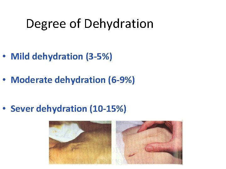 Degree of Dehydration • Mild dehydration (3 -5%) • Moderate dehydration (6 -9%) •