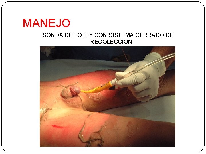 MANEJO SONDA DE FOLEY CON SISTEMA CERRADO DE RECOLECCION 