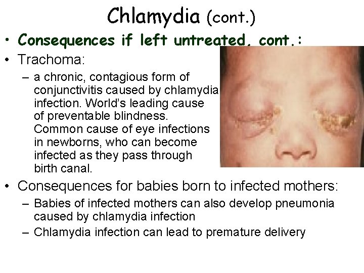 Chlamydia (cont. ) • Consequences if left untreated, cont. : • Trachoma: – a