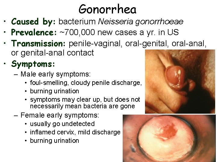 Gonorrhea • Caused by: bacterium Neisseria gonorrhoeae • Prevalence: ~700, 000 new cases a