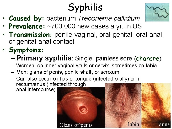 Syphilis • Caused by: bacterium Treponema pallidium • Prevalence: ~700, 000 new cases a