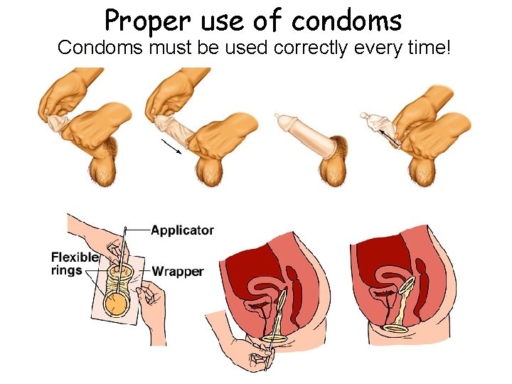 Proper use of condoms Condoms must be used correctly every time! 