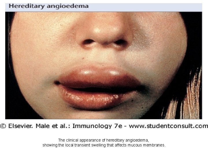 The clinical appearance of hereditary angioedema, showing the local transient swelling that affects mucous