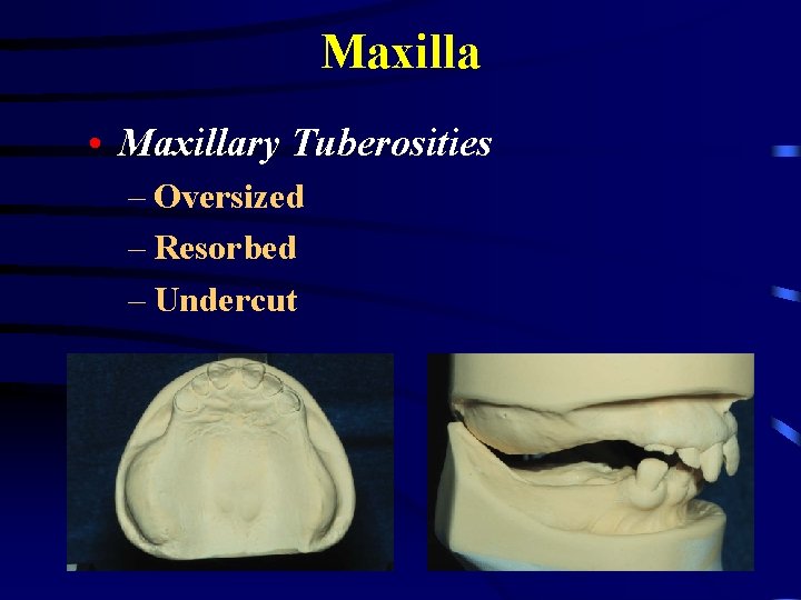 Maxilla • Maxillary Tuberosities – Oversized – Resorbed – Undercut 