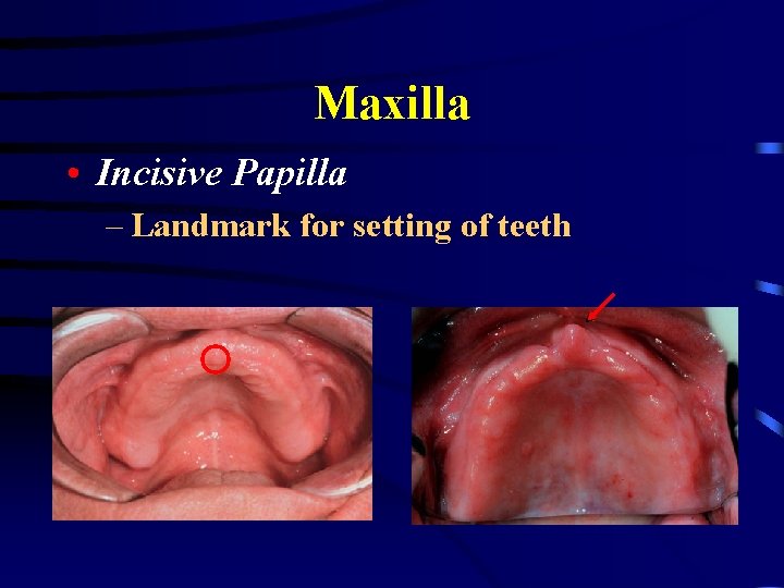 Maxilla • Incisive Papilla – Landmark for setting of teeth 