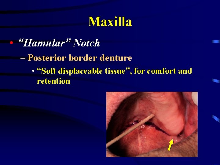 Maxilla • “Hamular” Notch – Posterior border denture • “Soft displaceable tissue”, for comfort