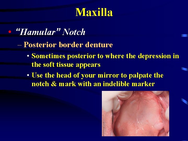 Maxilla • “Hamular” Notch – Posterior border denture • Sometimes posterior to where the