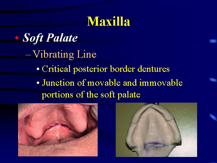 Maxilla • Soft Palate – Vibrating Line • Critical posterior border dentures • Junction
