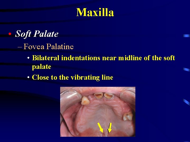 Maxilla • Soft Palate – Fovea Palatine • Bilateral indentations near midline of the