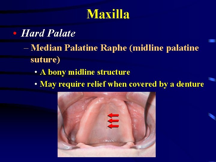 Maxilla • Hard Palate – Median Palatine Raphe (midline palatine suture) • A bony