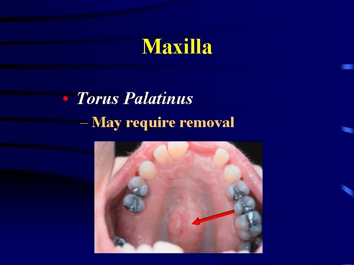 Maxilla • Torus Palatinus – May require removal 