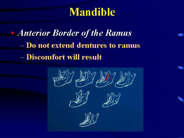 Mandible • Anterior Border of the Ramus – Do not extend dentures to ramus