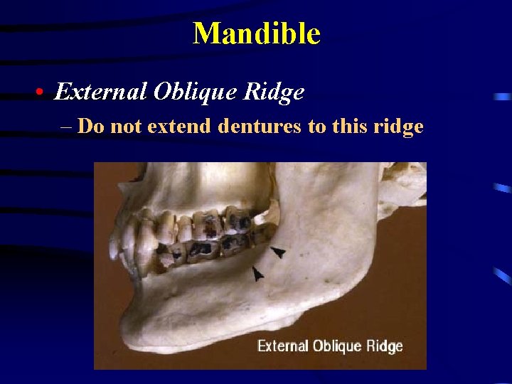 Mandible • External Oblique Ridge – Do not extend dentures to this ridge 