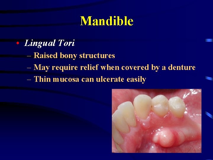 Mandible • Lingual Tori – Raised bony structures – May require relief when covered