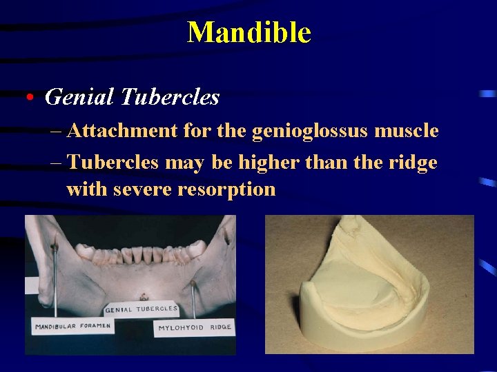 Mandible • Genial Tubercles – Attachment for the genioglossus muscle – Tubercles may be