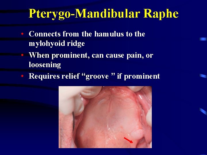 Pterygo-Mandibular Raphe • Connects from the hamulus to the mylohyoid ridge • When prominent,