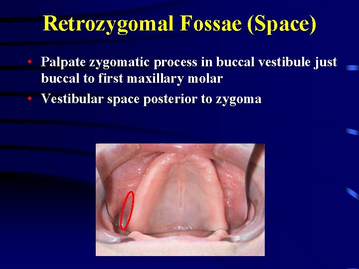 Retrozygomal Fossae (Space) • Palpate zygomatic process in buccal vestibule just buccal to first