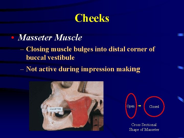 Cheeks • Masseter Muscle – Closing muscle bulges into distal corner of buccal vestibule