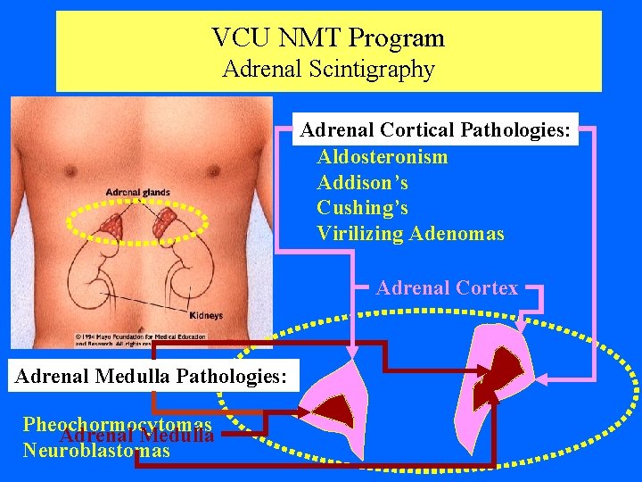 VCU NMT Program Adrenal Scintigraphy Adrenal Cortical Pathologies: Aldosteronism Addison’s Cushing’s Virilizing Adenomas Adrenal