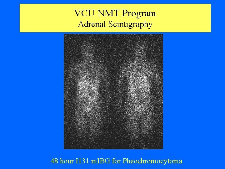 VCU NMT Program Adrenal Scintigraphy 48 hour I 131 m. IBG for Pheochromocytoma 
