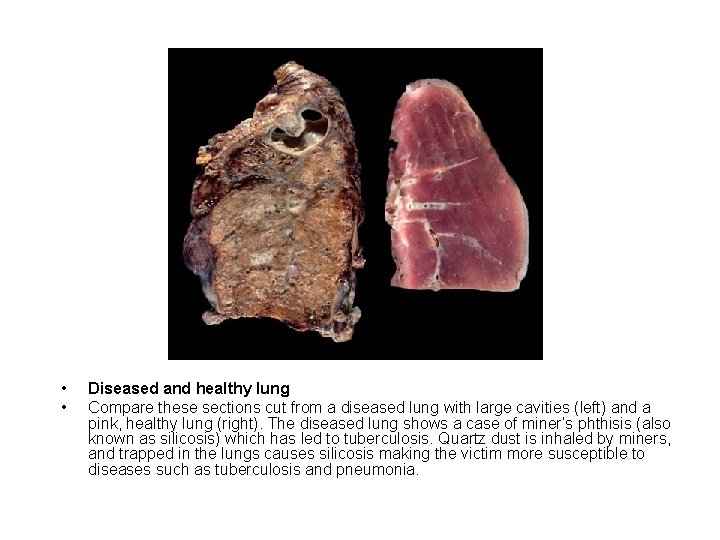 • • Diseased and healthy lung Compare these sections cut from a diseased • • Diseased and healthy lung Compare these sections cut from a diseased