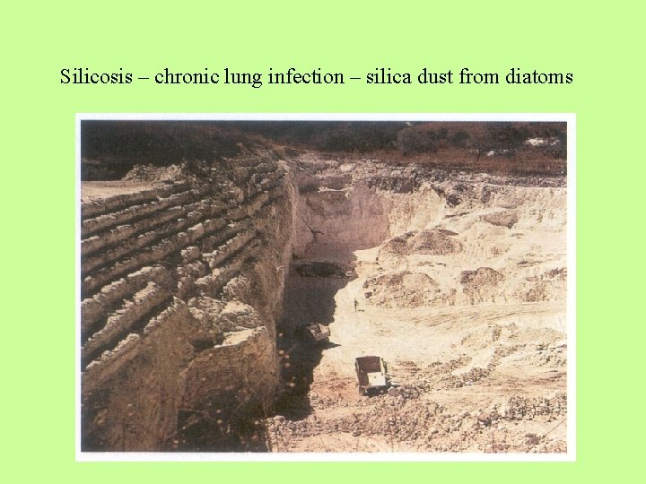 Silicosis – chronic lung infection – silica dust from diatoms 