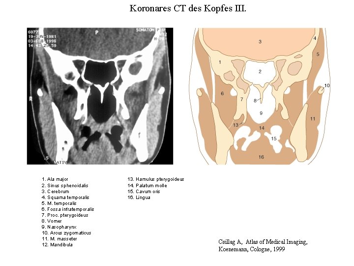 Koronares CT des Kopfes III. 1. Ala major 2. Sinus sphenoidalis 3. Cerebrum 4.